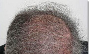 Hair restoration procedure results