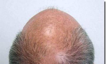 Hair restoration procedure results