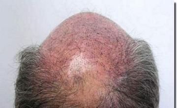 Hair restoration procedure results