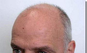 Hair restoration procedure results