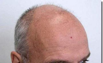 Hair restoration procedure results