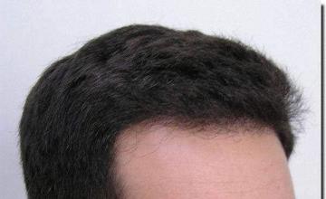 Hair restoration procedure results