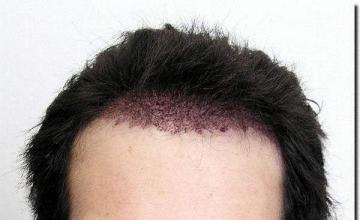 Hair restoration procedure results