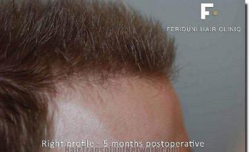 Hair restoration procedure results