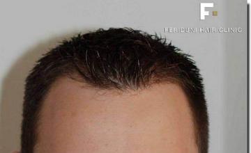 Hair restoration procedure results