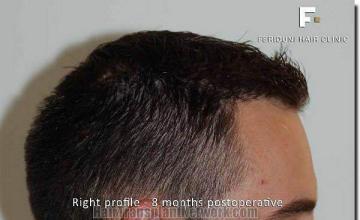 Hair restoration procedure results