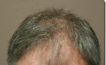 Hair restoration procedure results