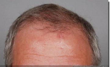 Hair restoration procedure results