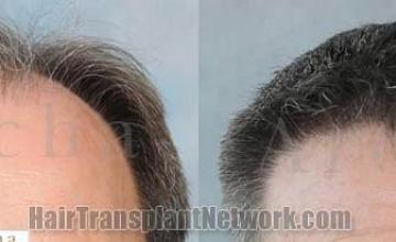 Hair restoration procedure before and after results