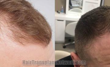 Hair restoration procedure before and after pictures