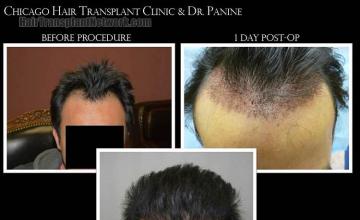 Hair restoration procedure before and after results