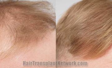 Hair restoration procedure before and after pictures