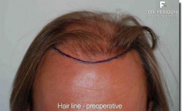 Hair restoration procedure results