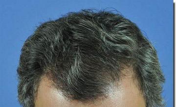 Hair restoration procedure results