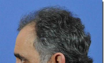 Hair restoration procedure results