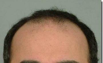 Hair restoration procedure results