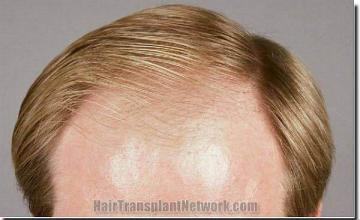 Hair restoration procedure results