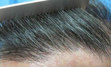 Hair restoration hairline closeup