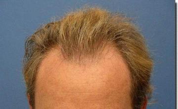 Hair restoration procedure results