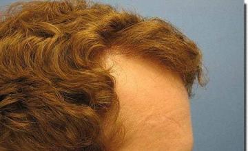 Hair restoration procedure results