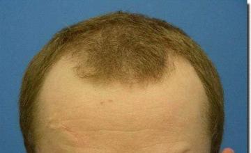 Hair restoration procedure results