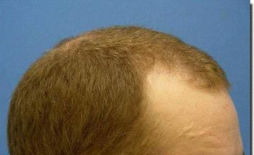 Hair restoration procedure results