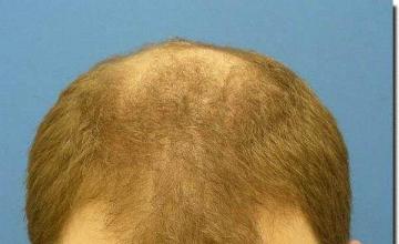 Hair restoration procedure results