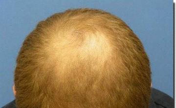 Hair restoration procedure results