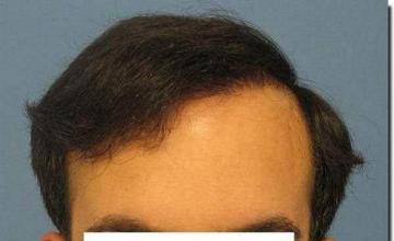 Hair restoration procedure results