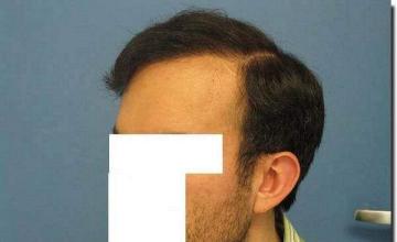 Hair restoration procedure results