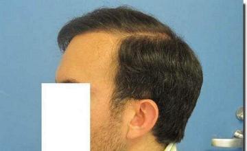 Hair restoration procedure results