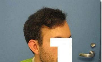 Hair restoration procedure results