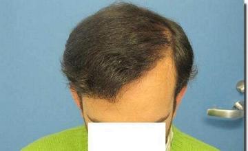 Hair restoration procedure results