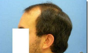 Hair restoration procedure results