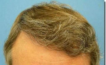 Hair restoration procedure results