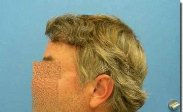 Hair restoration procedure results