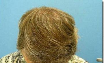 Hair restoration procedure results