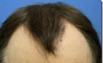 Hair restoration procedure results