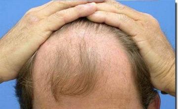 Hair restoration procedure results