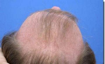 Hair restoration procedure results