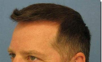 Hair restoration procedure results