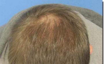 Hair restoration procedure results