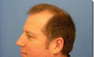 Hair restoration procedure results