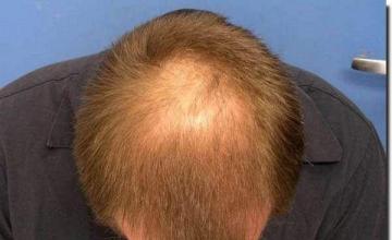 Hair restoration procedure results