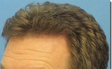 Hair restoration procedure results