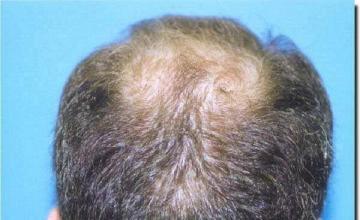 Hair restoration procedure results