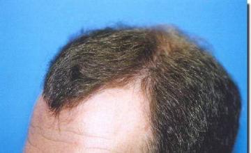 Hair restoration procedure results