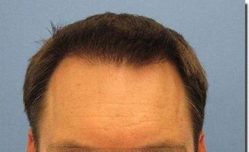 Hair restoration procedure results