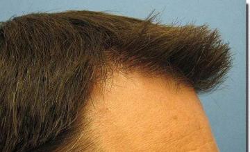 Hair restoration procedure results