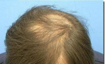 Hair restoration procedure results